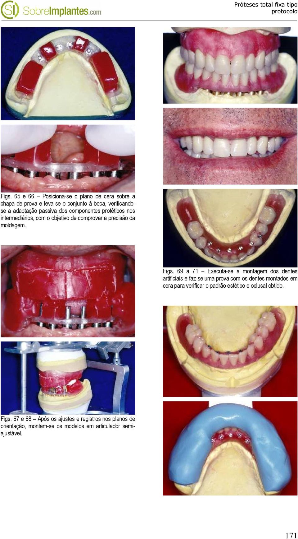 69 a 71 Executa-se a montagem dos dentes artificiais e faz-se uma prova com os dentes montados em cera para verificar o padrão