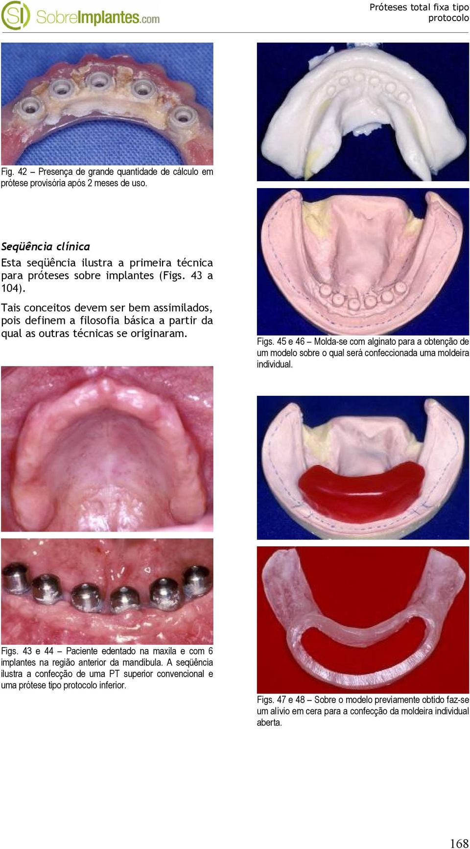 45 e 46 Molda-se com alginato para a obtenção de um modelo sobre o qual será confeccionada uma moldeira individual. Figs.