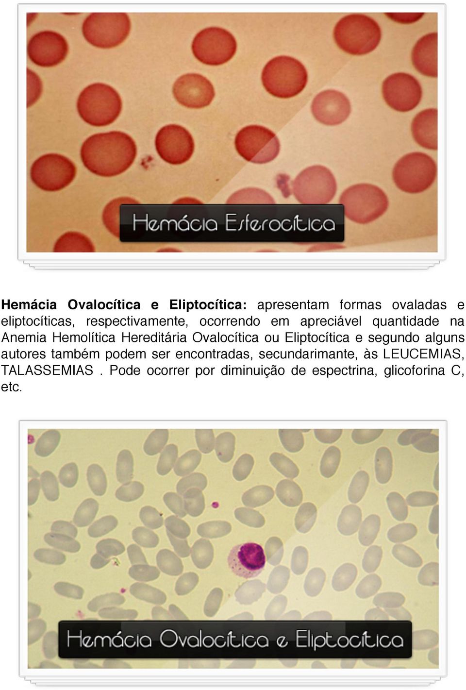 Ovalocítica ou Eliptocítica e segundo alguns autores também podem ser encontradas,