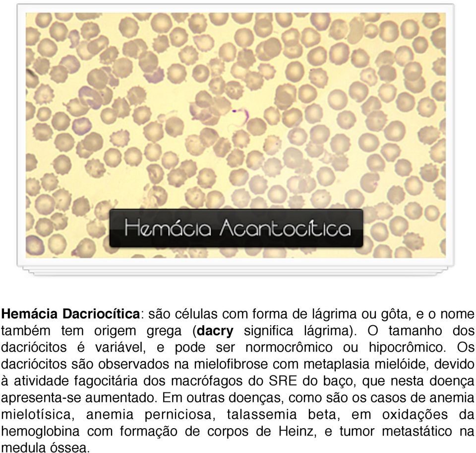 Os dacriócitos são observados na mielofibrose com metaplasia mielóide, devido à atividade fagocitária dos macrófagos do SRE do baço, que nesta