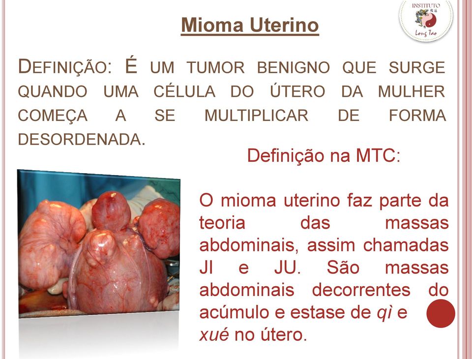 Definição na MTC: O mioma uterino faz parte da teoria das massas abdominais,