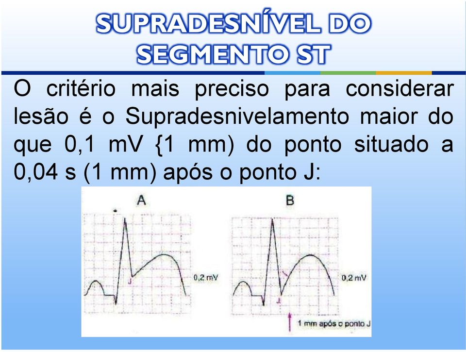 Supradesnivelamento maior do que 0,1 mv {1