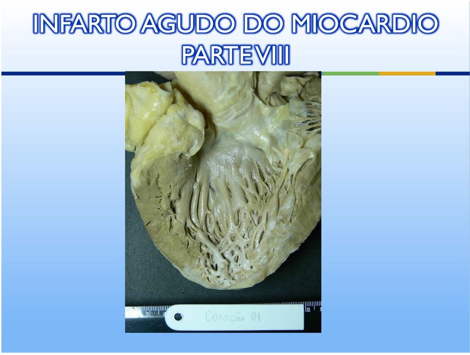 MIOCARDIO