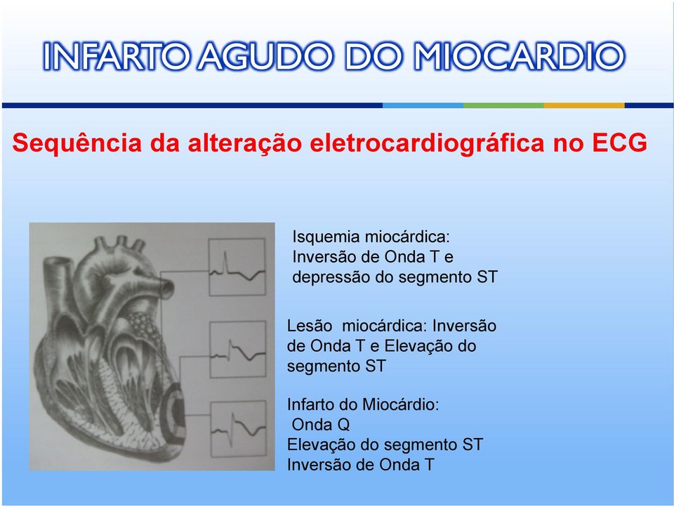 segmento ST Lesão miocárdica: Inversão de Onda T e Elevação do