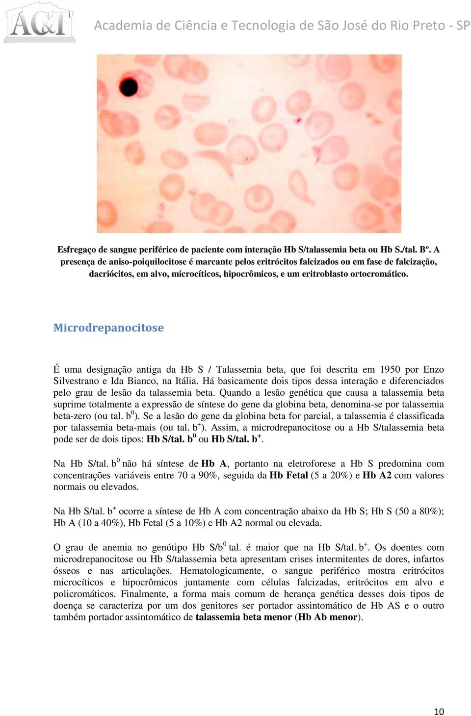 Microdrepanocitose É uma designação antiga da Hb S / Talassemia beta, que foi descrita em 1950 por Enzo Silvestrano e Ida Bianco, na Itália.