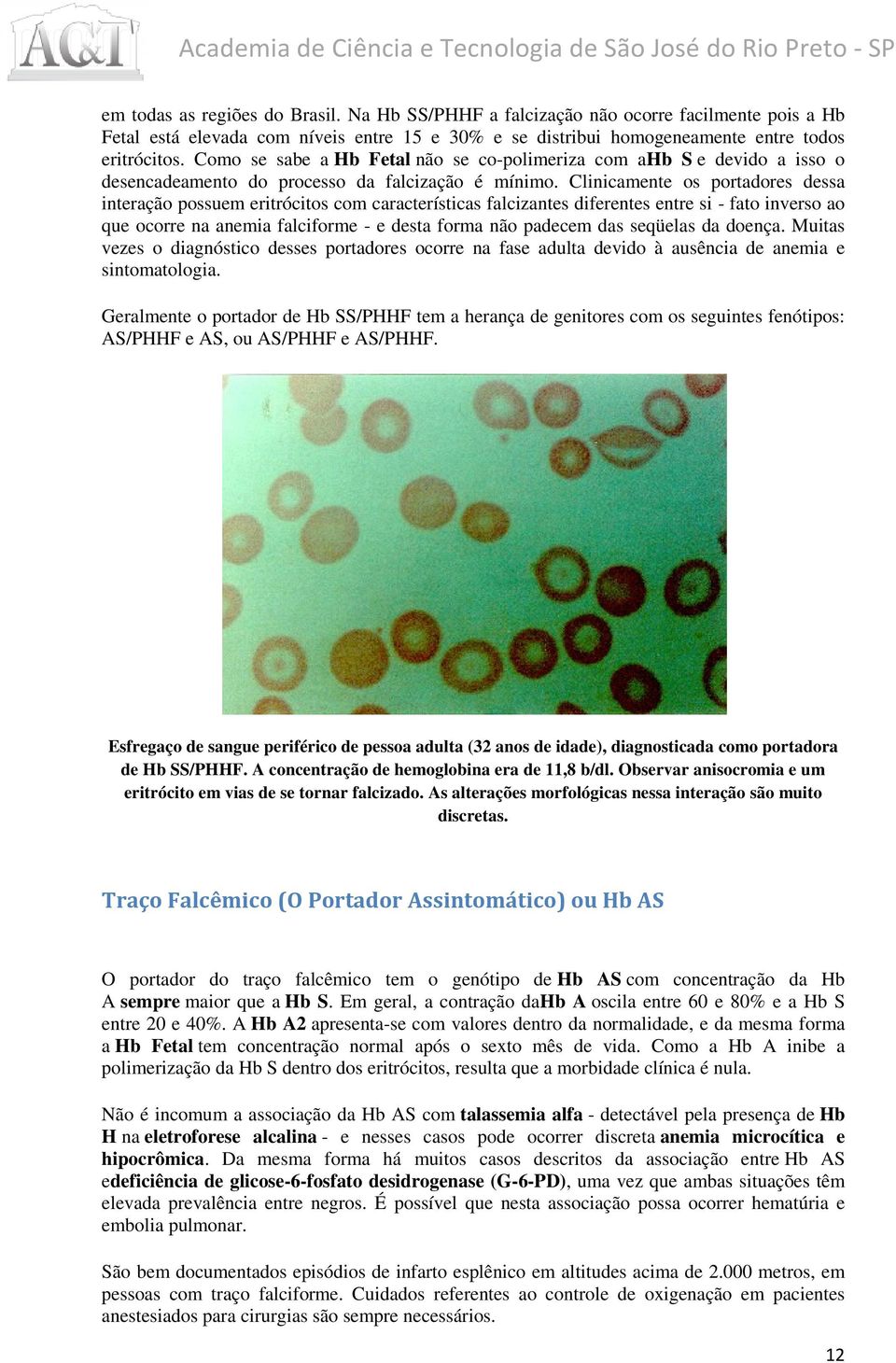 Clinicamente os portadores dessa interação possuem eritrócitos com características falcizantes diferentes entre si - fato inverso ao que ocorre na anemia a falciforme - e desta forma não padecem das