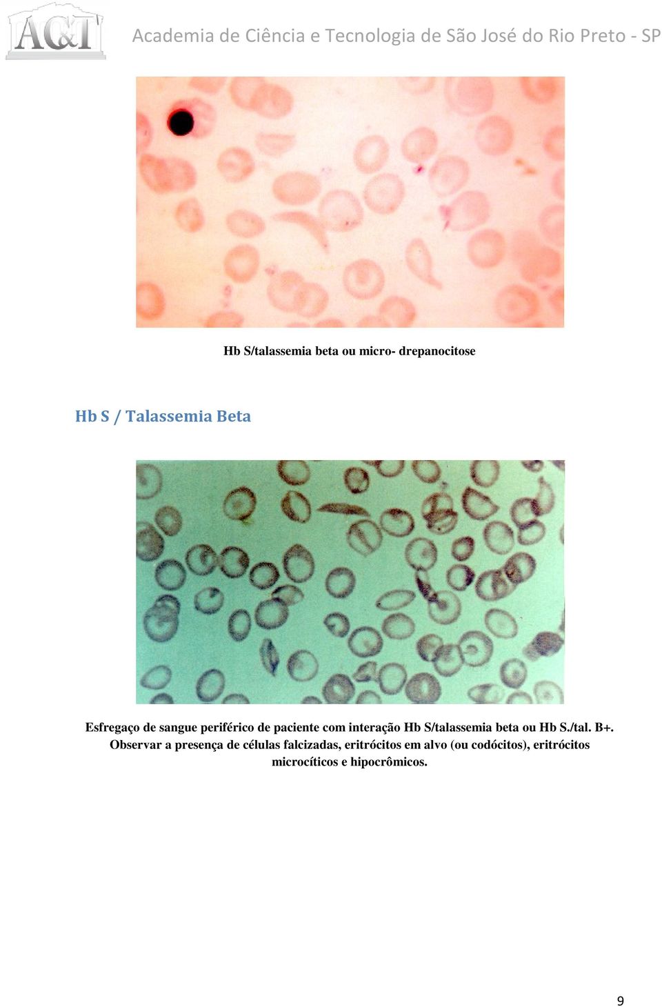 S/talassemia beta ou Hb S./tal. B+.