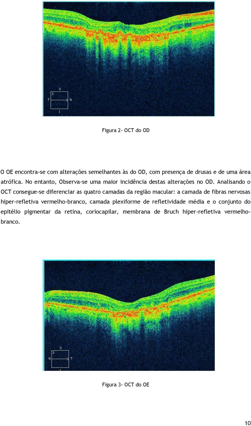 Analisando o OCT consegue-se diferenciar as quatro camadas da região macular: a camada de fibras nervosas hiper-refletiva