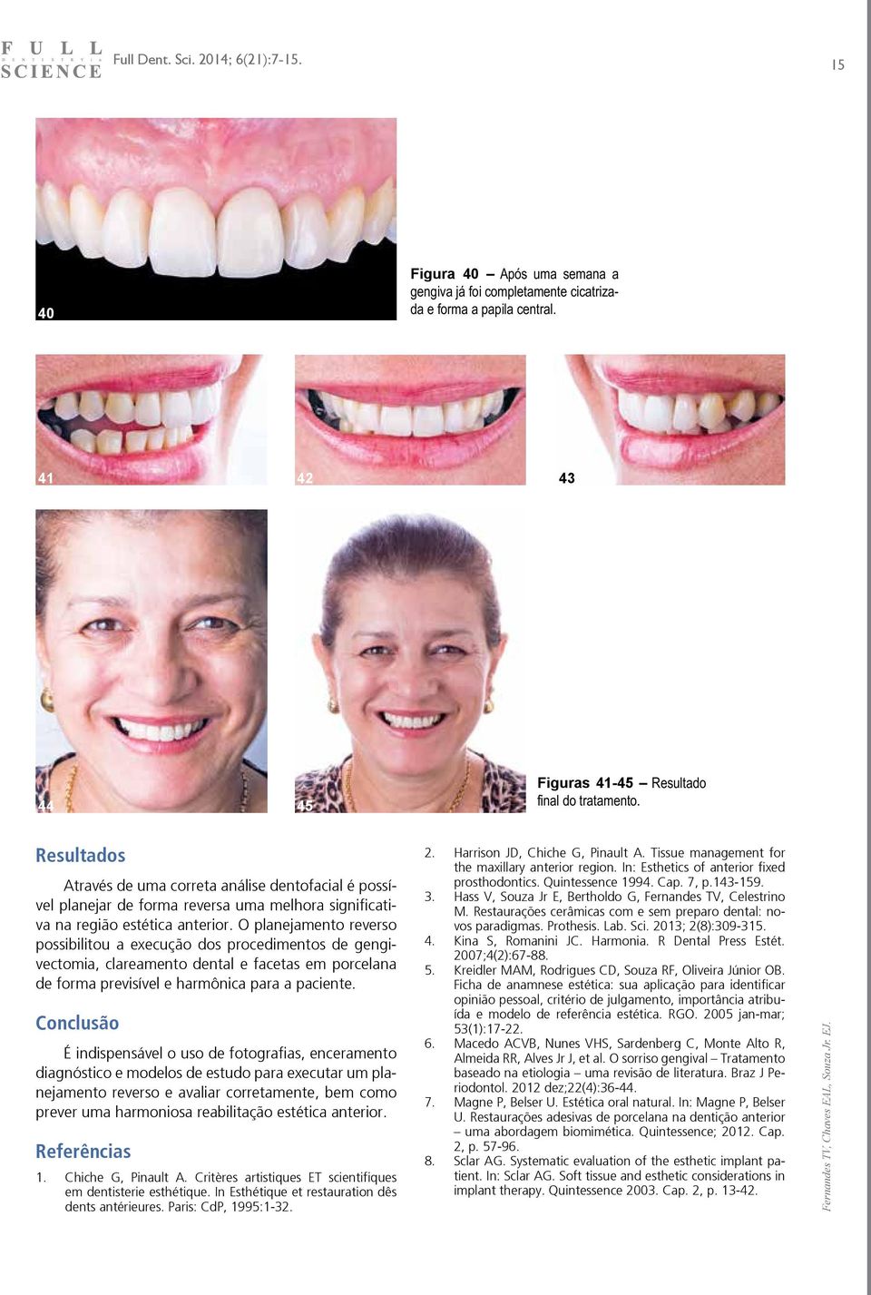 O planejamento reverso possibilitou a execução dos procedimentos de gengivectomia, clareamento dental e facetas em porcelana de forma previsível e harmônica para a paciente.