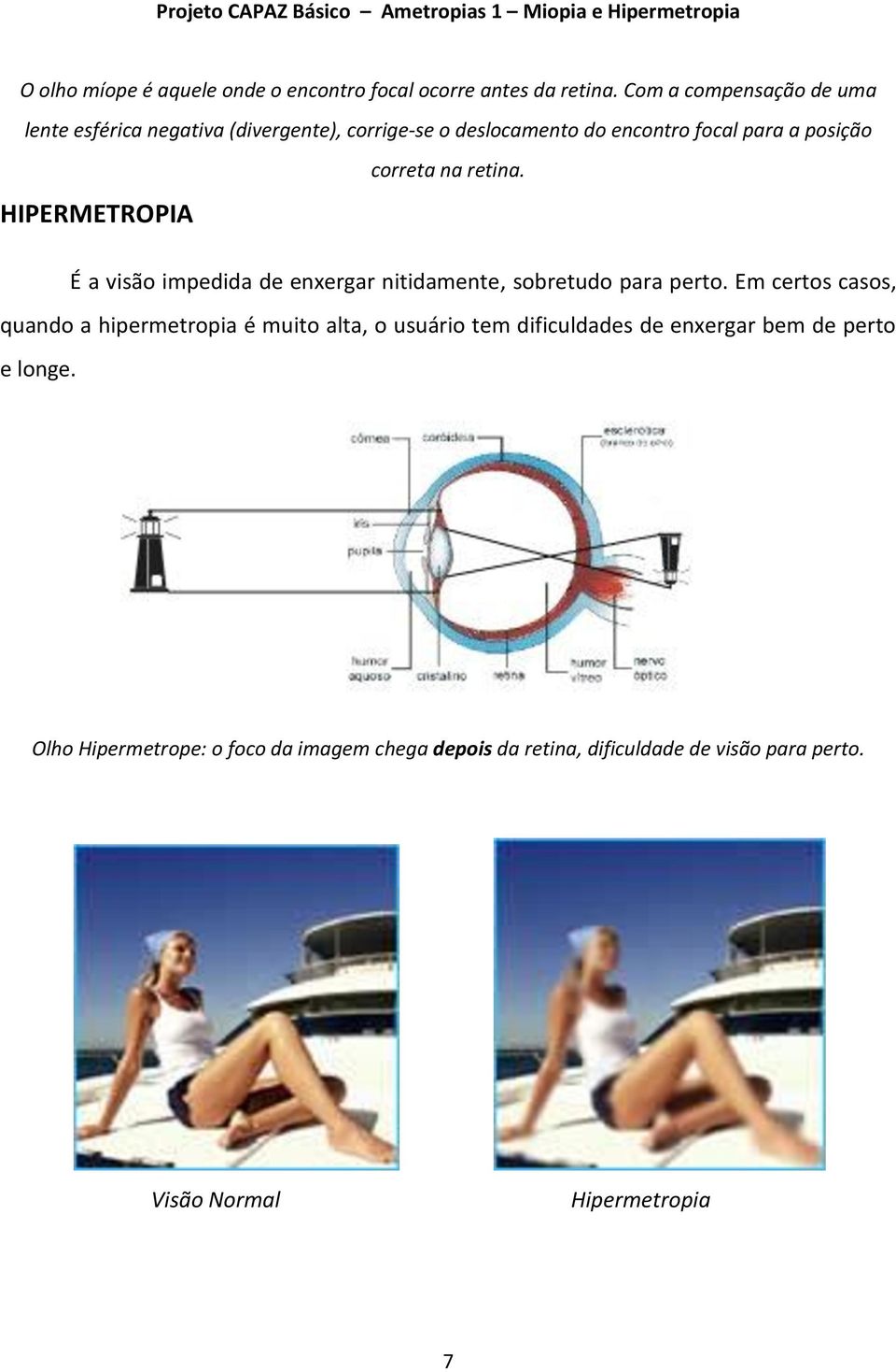 HIPERMETROPIA correta na retina. É a visão impedida de enxergar nitidamente, sobretudo para perto.