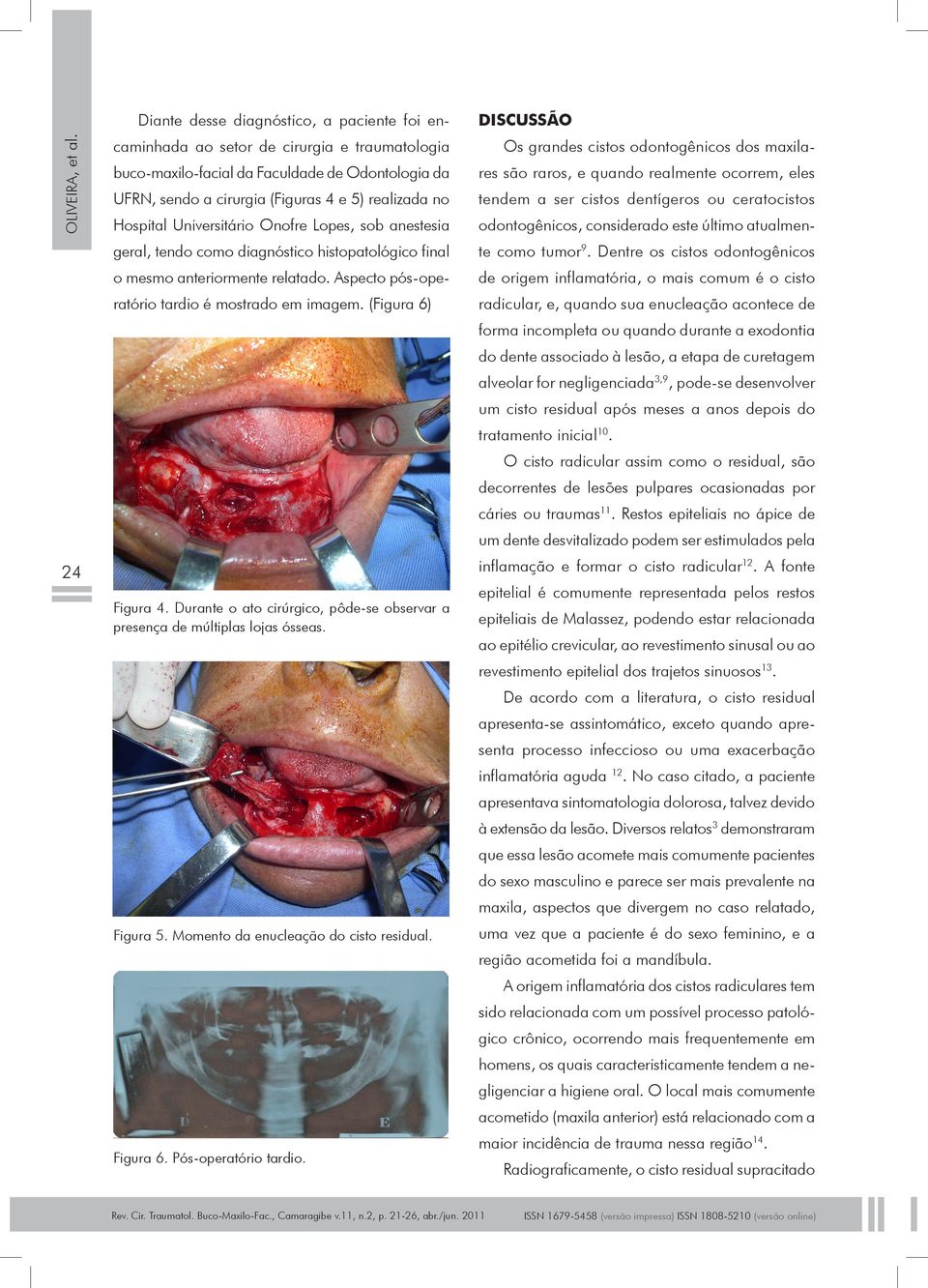 Hospital Universitário Onofre Lopes, sob anestesia geral, tendo como diagnóstico histopatológico final o mesmo anteriormente relatado. Aspecto pós-operatório tardio é mostrado em imagem.
