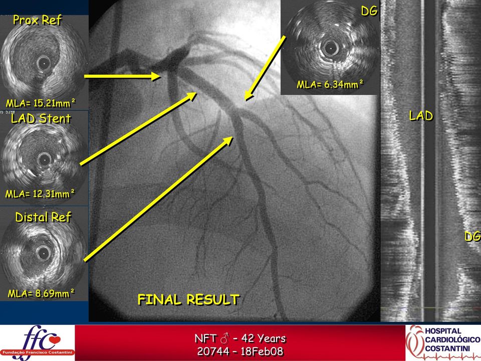 31mm² Distal Ref DG MLA= 8.