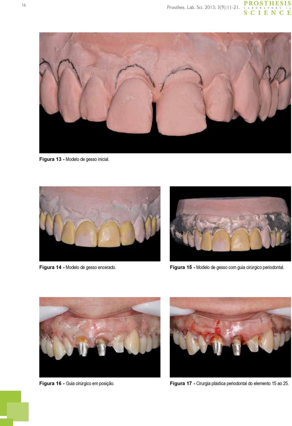 Figura 15 - Modelo de gesso com guia cirúrgico periodontal.