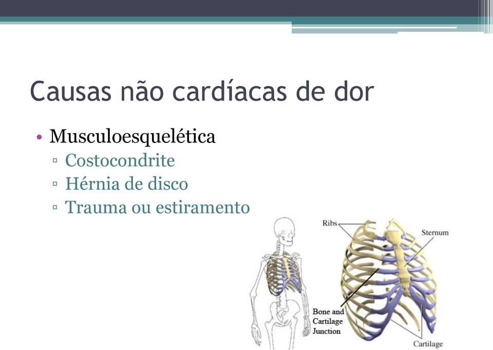 Costocondrite Hérnia de