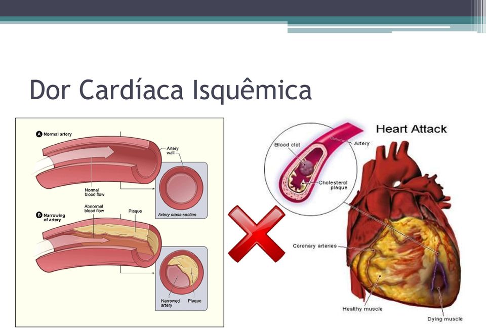 Isquêmica