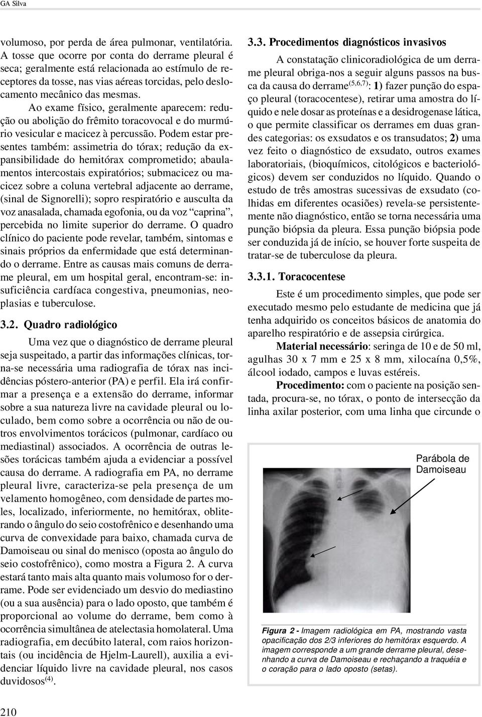 Ao exame fïsico, geralmente aparecem: redução ou abolição do frêmito toracovocal e do murmúrio vesicular e macicez à percussão.