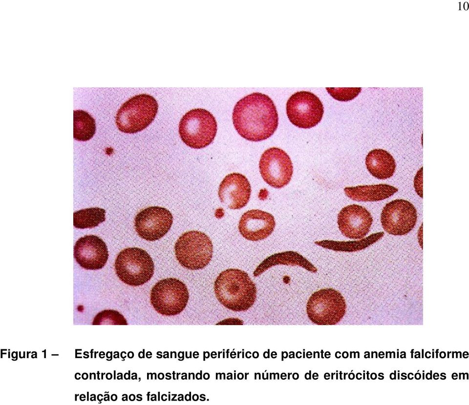 falciforme controlada, mostrando maior