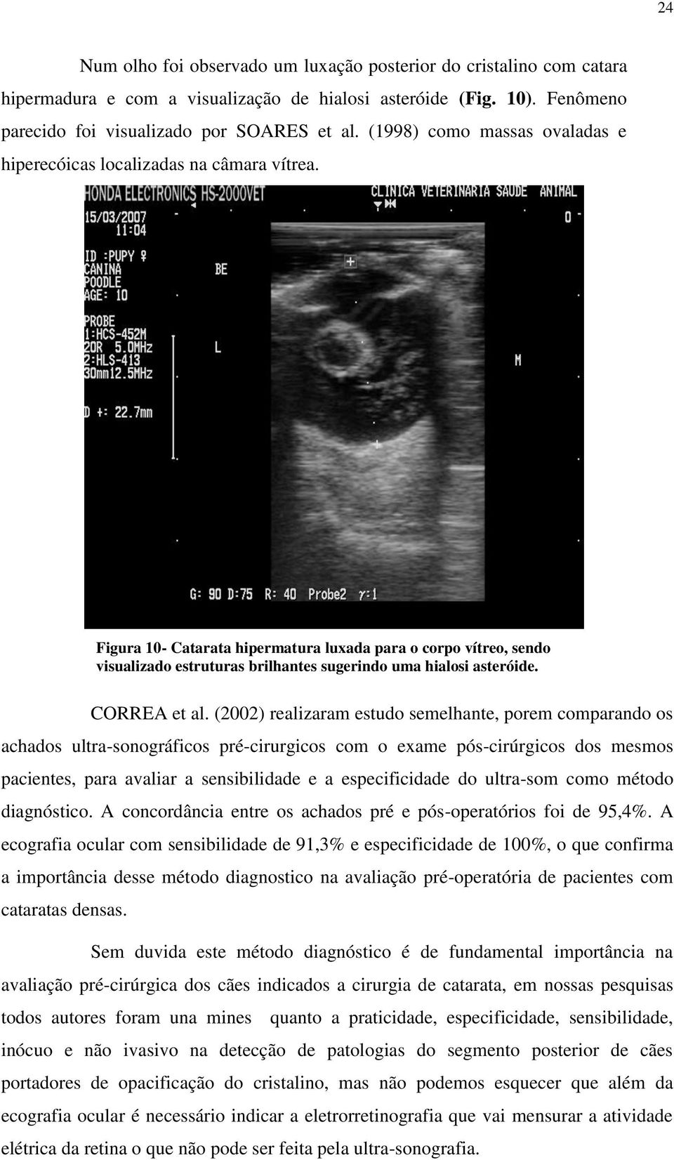 Figura 10- Catarata hipermatura luxada para o corpo vítreo, sendo visualizado estruturas brilhantes sugerindo uma hialosi asteróide. CORREA et al.