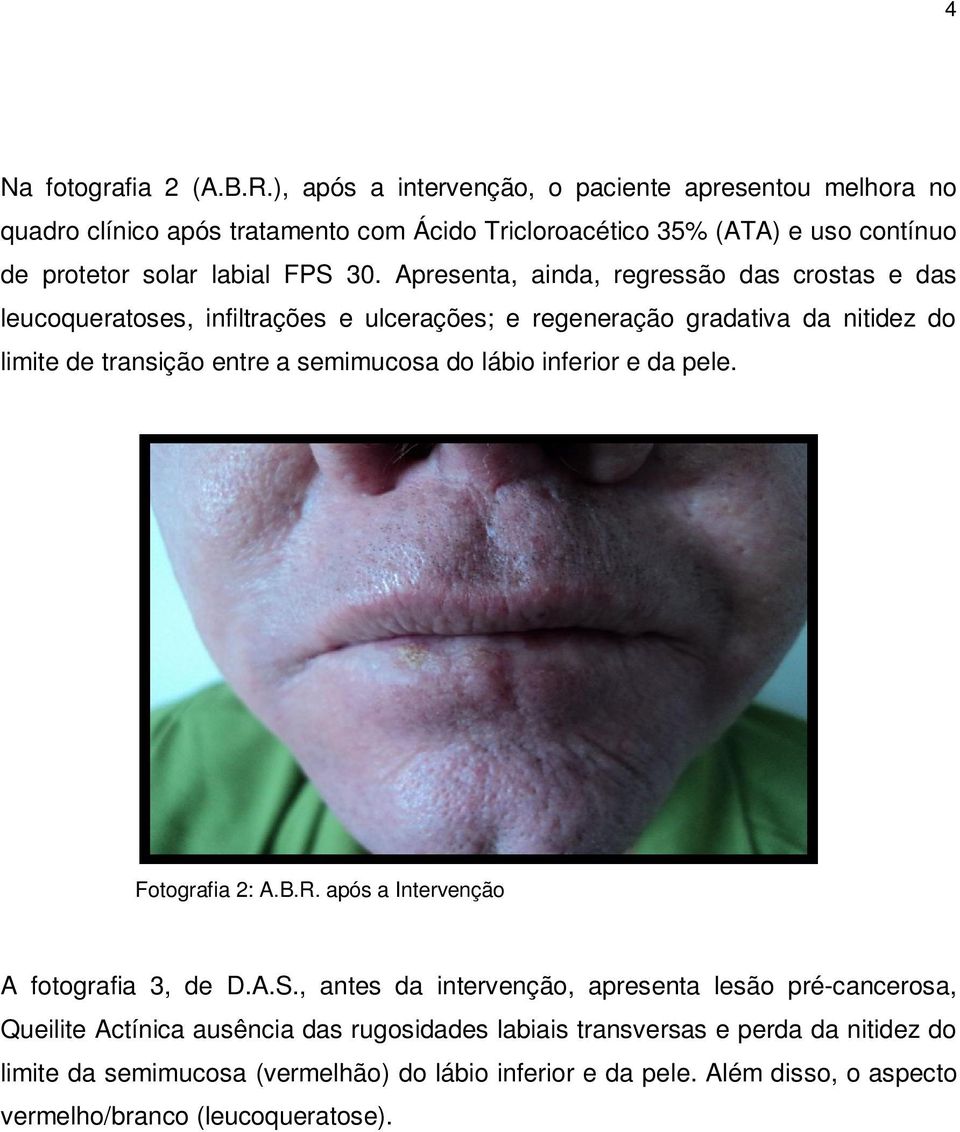 Apresenta, ainda, regressão das crostas e das leucoqueratoses, infiltrações e ulcerações; e regeneração gradativa da nitidez do limite de transição entre a semimucosa do lábio