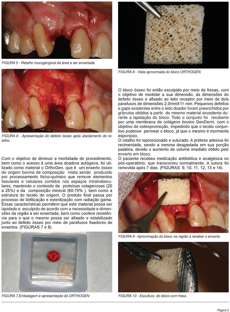 mista sendo produzido por processamento físico-químico que remove elementos tissulares e celulares contidos nos espaços intratrabeculares, mantendo o conteúdo de proteínas colagenosas (20 a 25%) e da