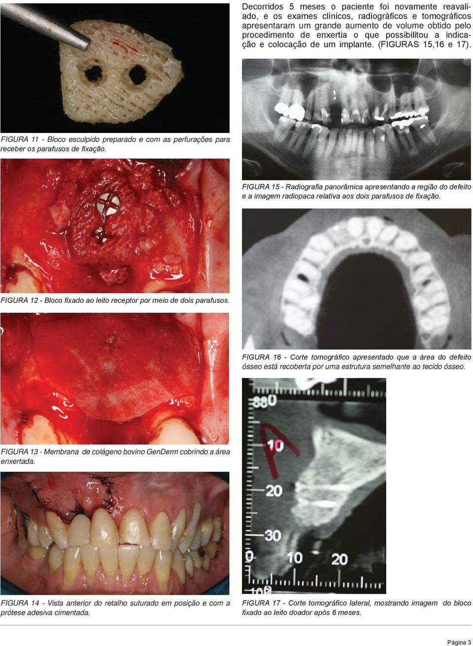 FIGURA 15 - Radiografia panorâmica apresentando a região do defeito e a imagem radiopaca relativa aos dois parafusos de fixação. FIGURA 12 - Bloco fixado ao leito receptor por meio de dois parafusos.