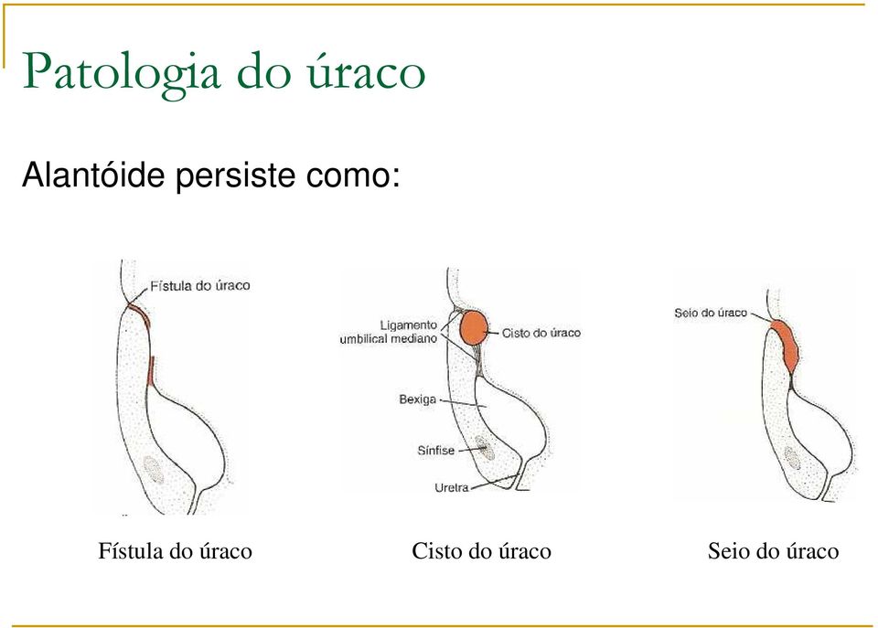 como: Fístula do úraco