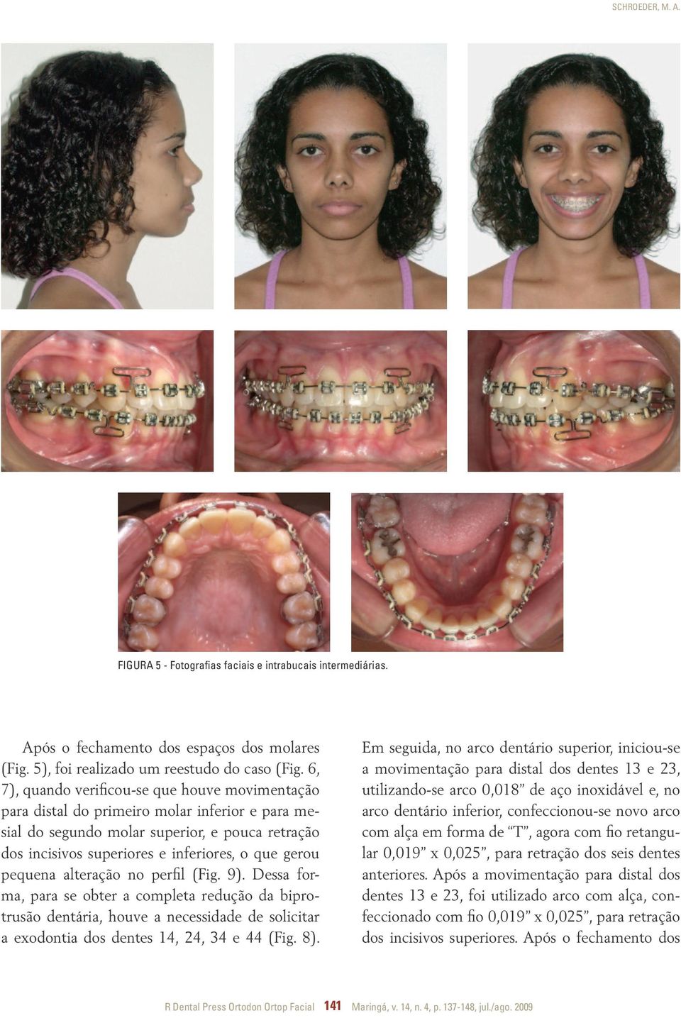 pequena alteração no perfil (Fig. 9). Dessa forma, para se obter a completa redução da biprotrusão dentária, houve a necessidade de solicitar a exodontia dos dentes 14, 24, 34 e 44 (Fig. 8).