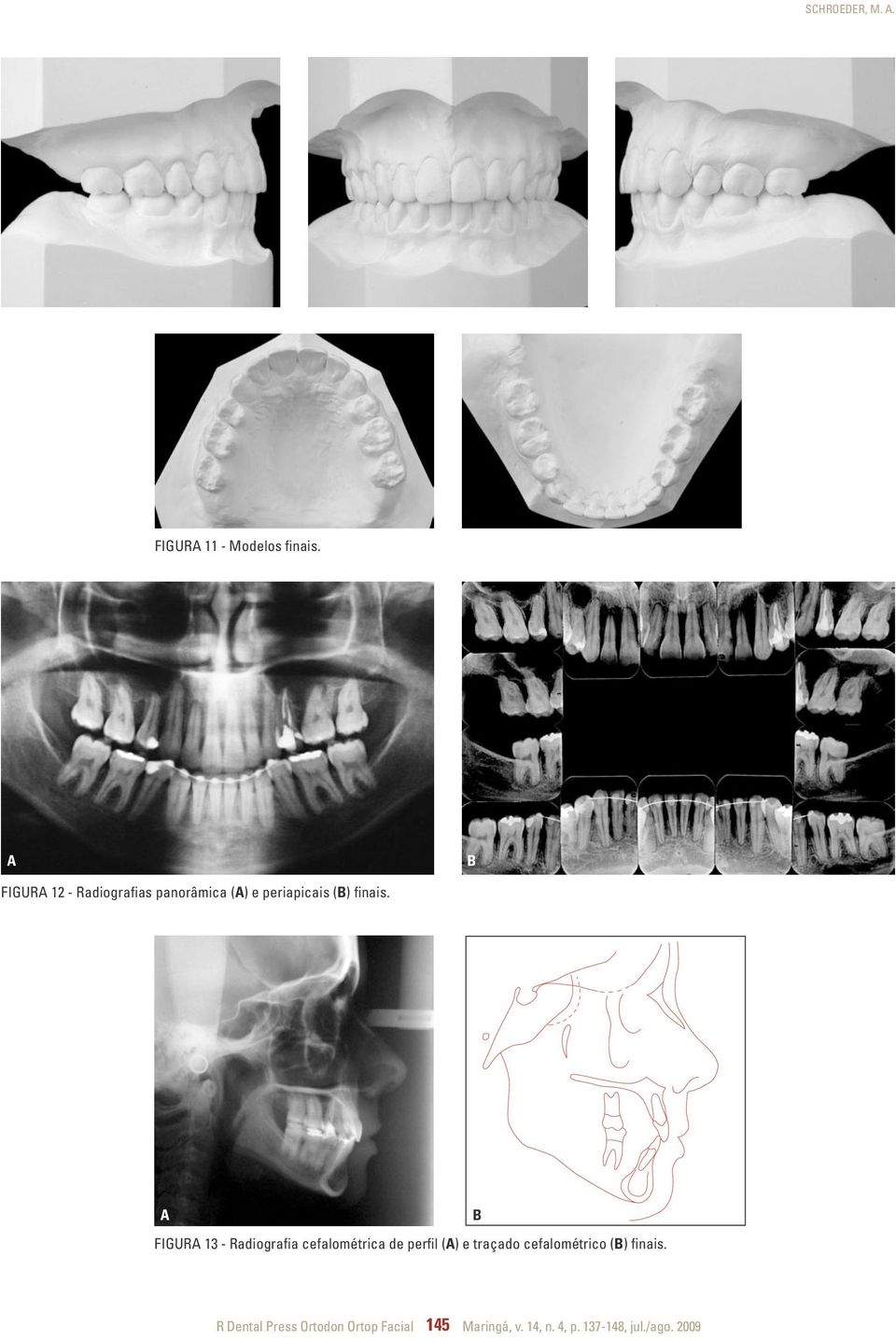 FIGUR 13 - Radiografia cefalométrica de perfil () e traçado