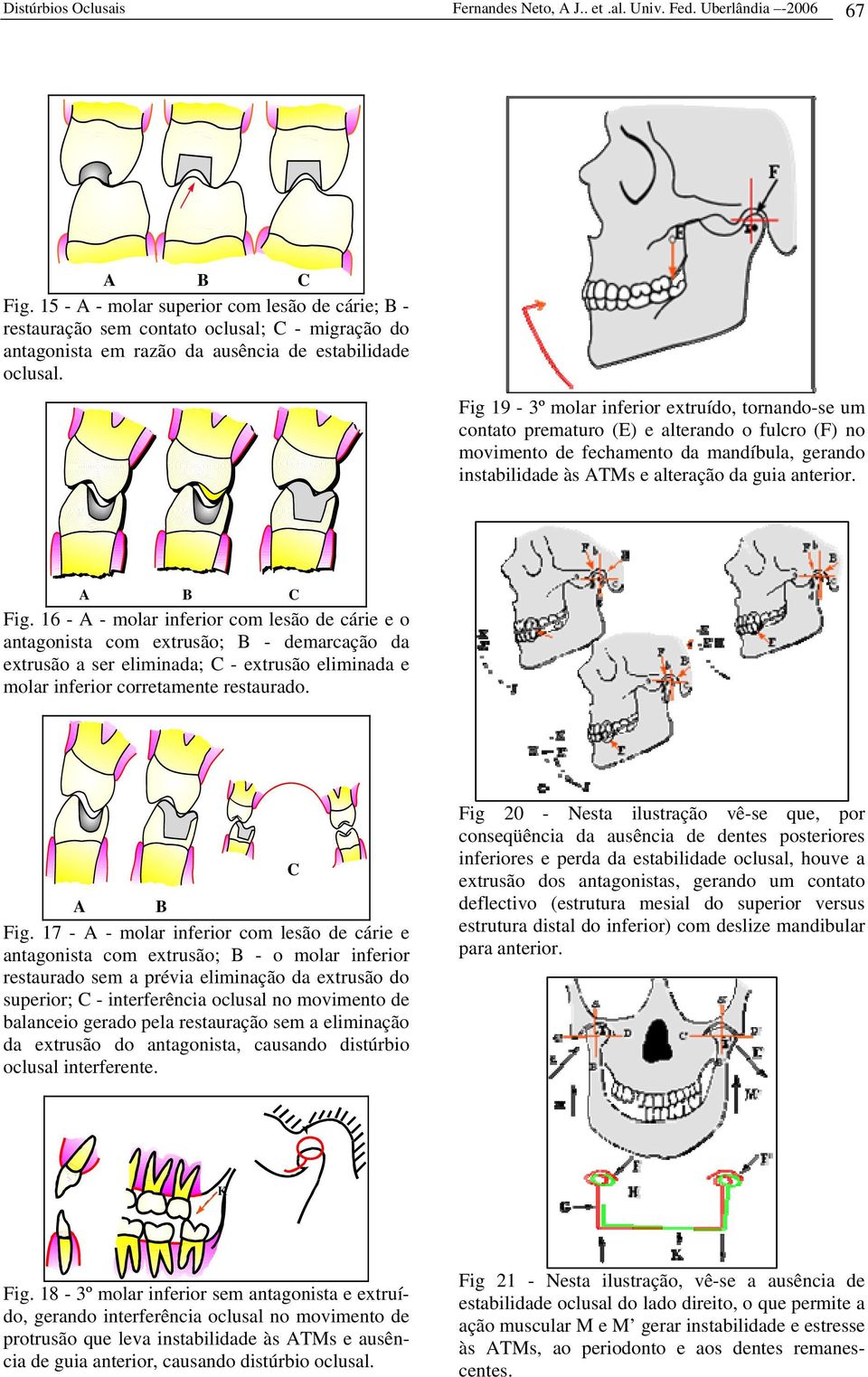 Fig 19-3º molar inferior extruído, tornando-se um contato prematuro (E) e alterando o fulcro (F) no movimento de fechamento da mandíbula, gerando instabilidade às ATMs e alteração da guia anterior.