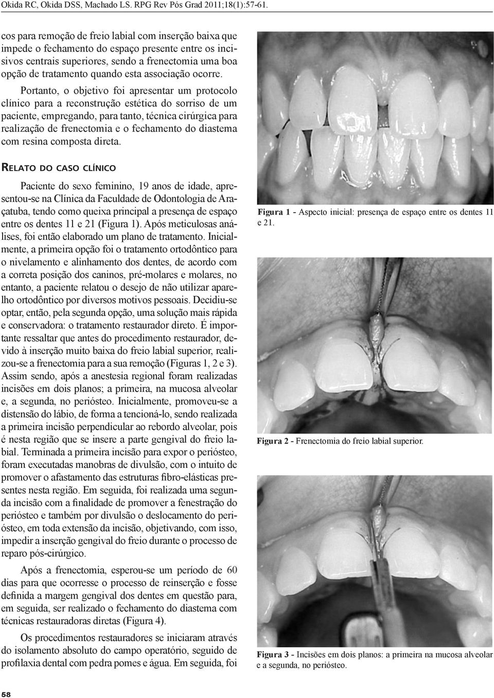 Portanto, o objetivo foi apresentar um protocolo clínico para a reconstrução estética do sorriso de um paciente, empregando, para tanto, técnica cirúrgica para realização de frenectomia e o