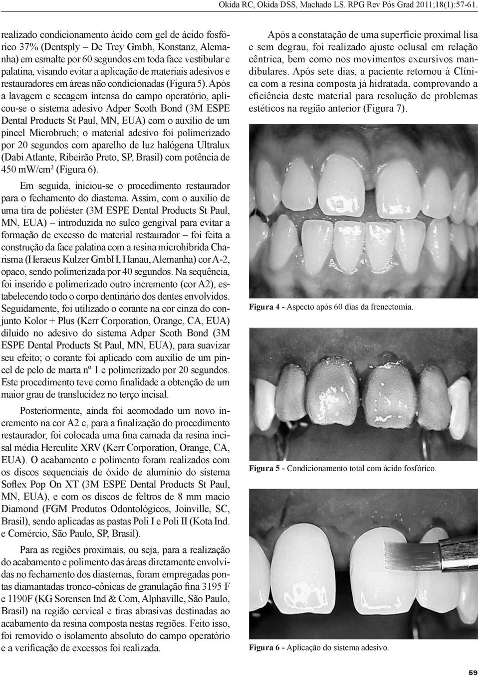 Após a lavagem e secagem intensa do campo operatório, aplicou-se o sistema adesivo Adper Scoth Bond (3M ESPE Dental Products St Paul, MN, EUA) com o auxílio de um pincel Microbruch; o material