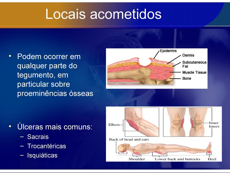 particular sobre proeminências ósseas