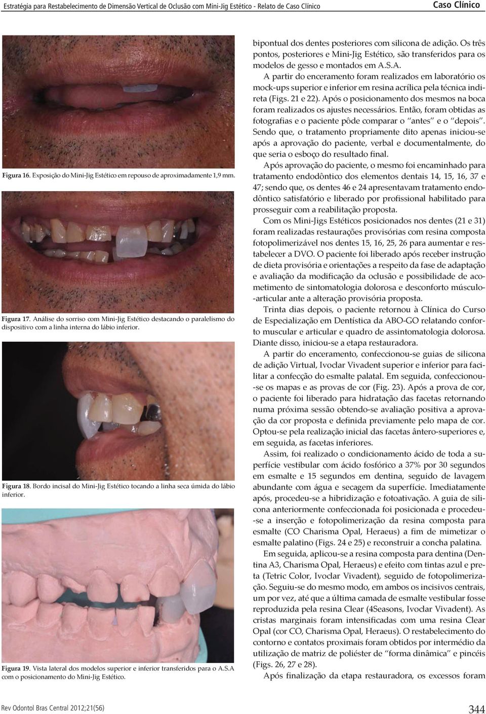 Bordo incisal do Mini-Jig Estético tocando a linha seca úmida do lábio inferior. Figura 19. Vista lateral dos modelos superior e inferior transferidos para o A.S.