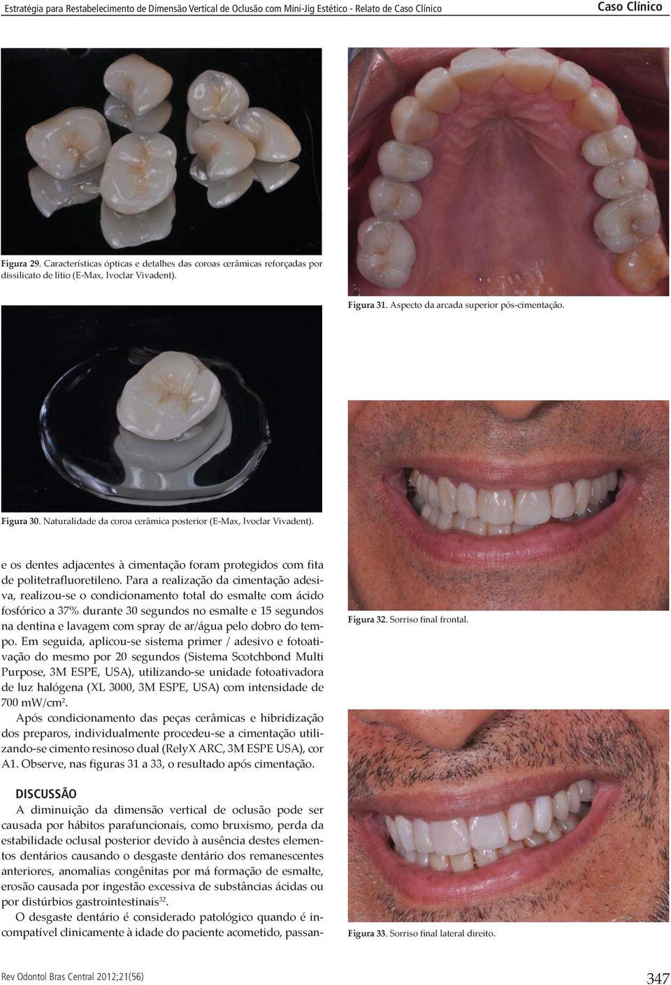 Naturalidade da coroa cerâmica posterior (E-Max, Ivoclar Vivadent). e os dentes adjacentes à cimentação foram protegidos com fita de politetrafluoretileno.