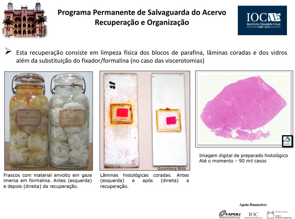 preparado histológico Até o momento 90 mil casos Frascos com material envolto em gaze imersa em formalina.