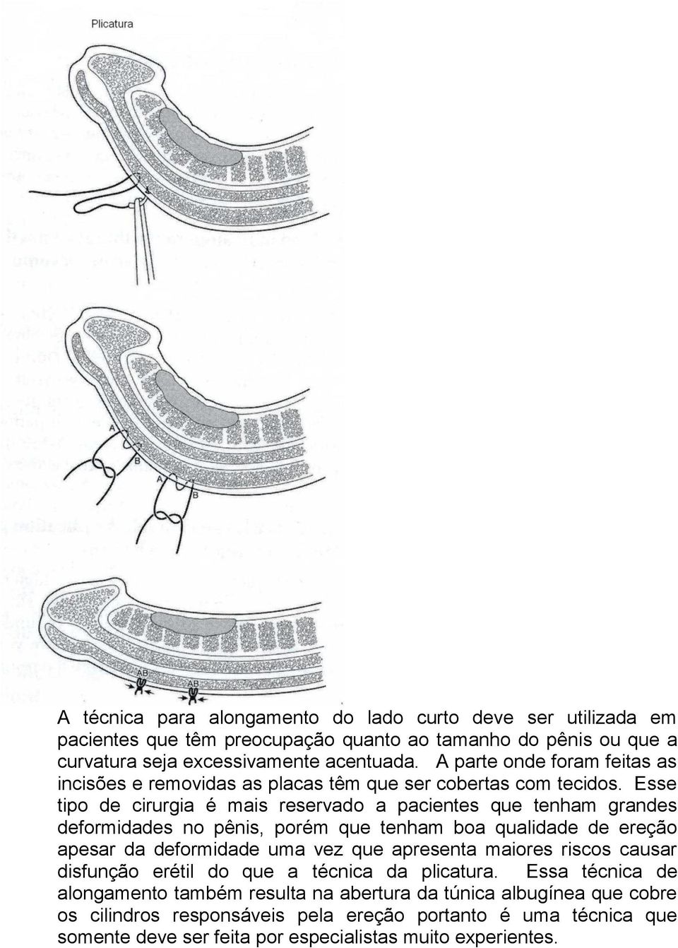 Esse tipo de cirurgia é mais reservado a pacientes que tenham grandes deformidades no pênis, porém que tenham boa qualidade de ereção apesar da deformidade uma vez que apresenta