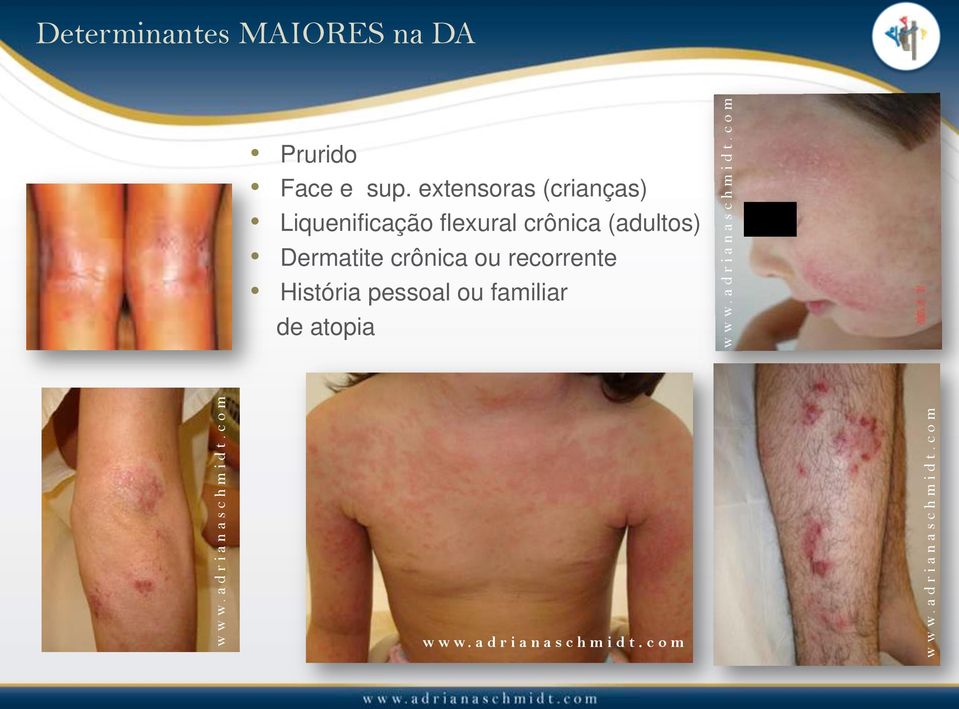 Dermatite crônica ou recorrente História pessoal ou familiar de