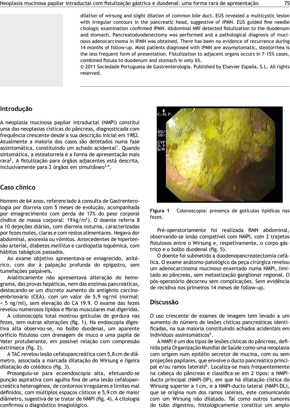 Abdominal MRI detected fistulization to the duodenum and stomach. Pancreatoduodenectomy was performed and a pathological diagnosis of mucinous adenocarcinoma in IPMN was obtained.