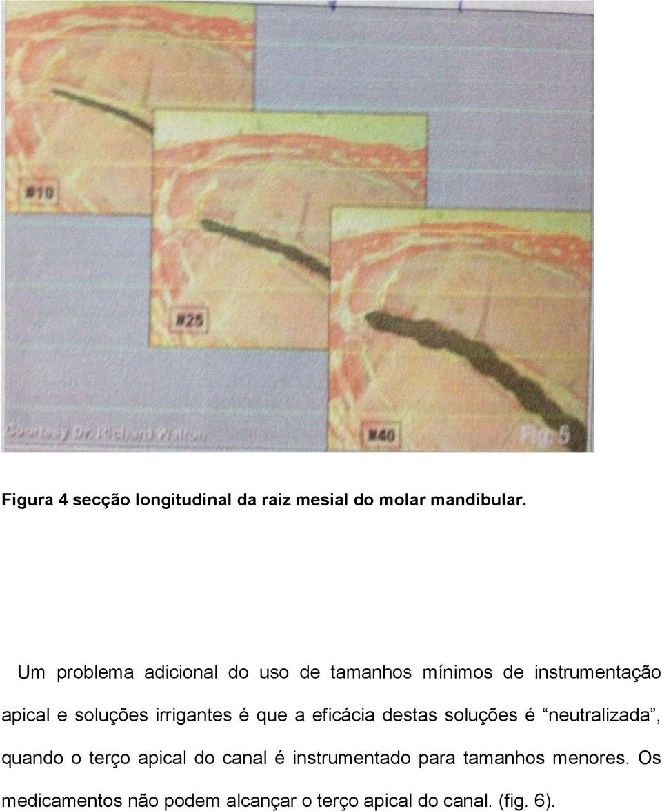 irrigantes é que a eficácia destas soluções é neutralizada, quando o terço apical do