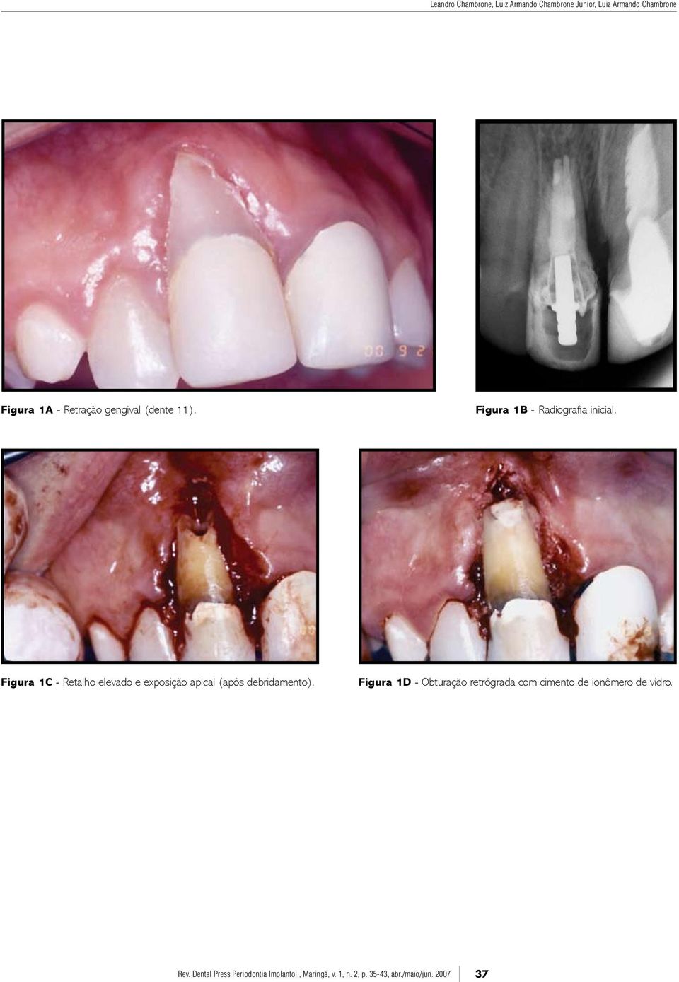 Figura 1B - Radiografia inicial.