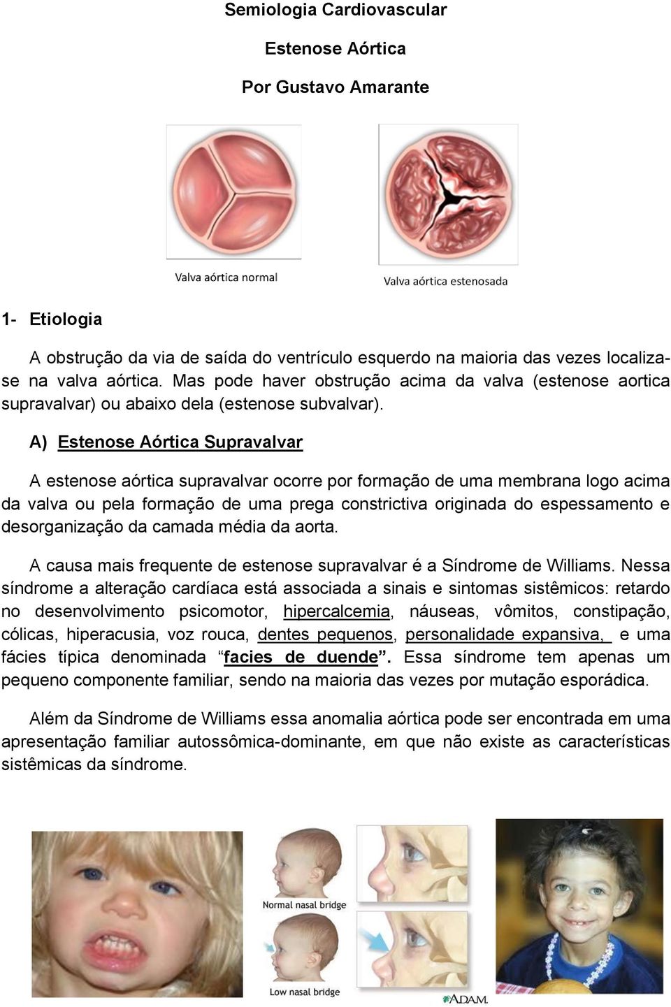 A) Estenose Aórtica Supravalvar A estenose aórtica supravalvar ocorre por formação de uma membrana logo acima da valva ou pela formação de uma prega constrictiva originada do espessamento e