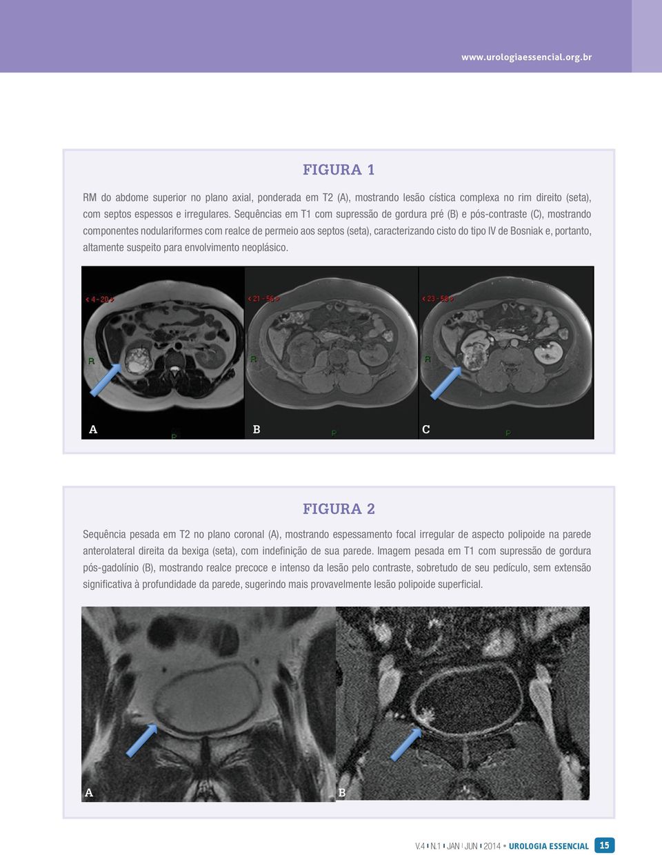 portanto, altamente suspeito para envolvimento neoplásico.