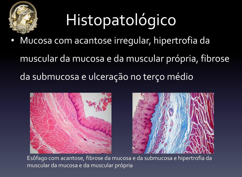 ulceração no terço médio Esôfago com acantose, fibrose da mucosa