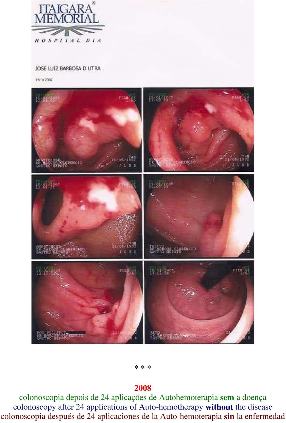 applications of Auto-hemotherapy without the disease