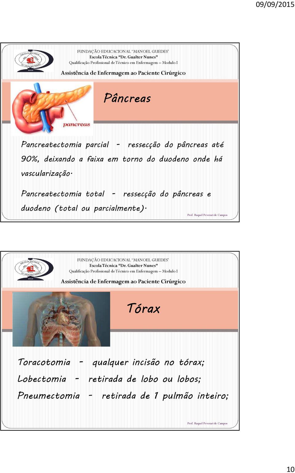 Pancreatectomia total - ressecção do pâncreas e duodeno (total ou parcialmente).