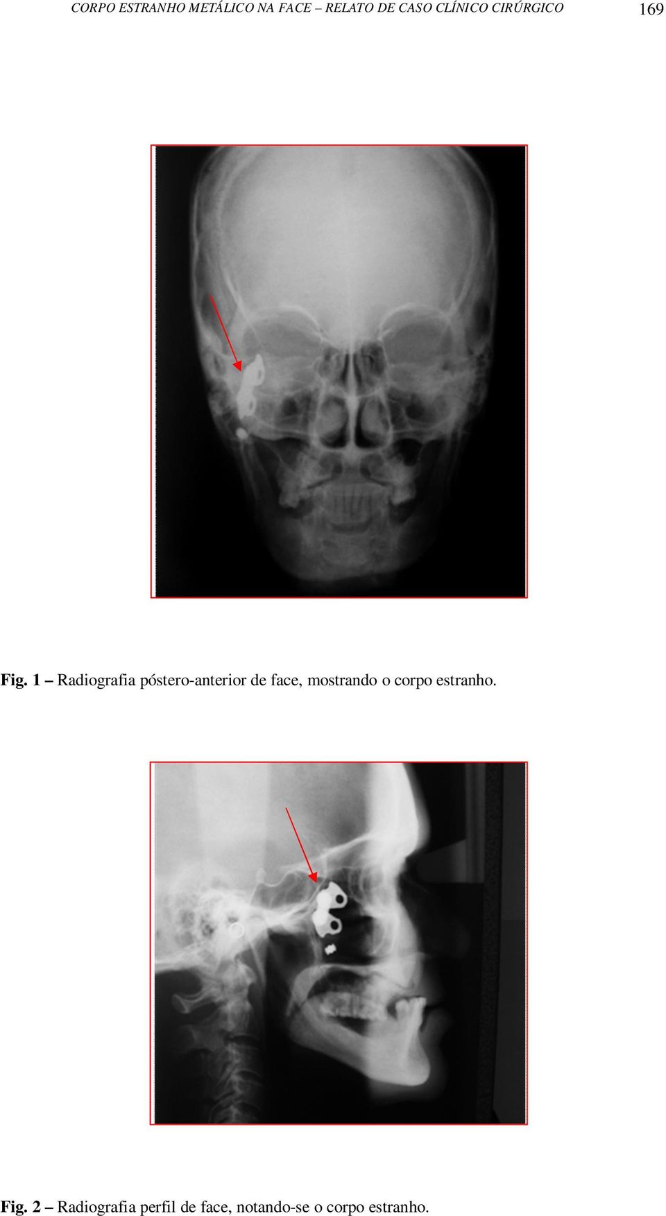 1 Radiografia póstero-anterior de face, mostrando o