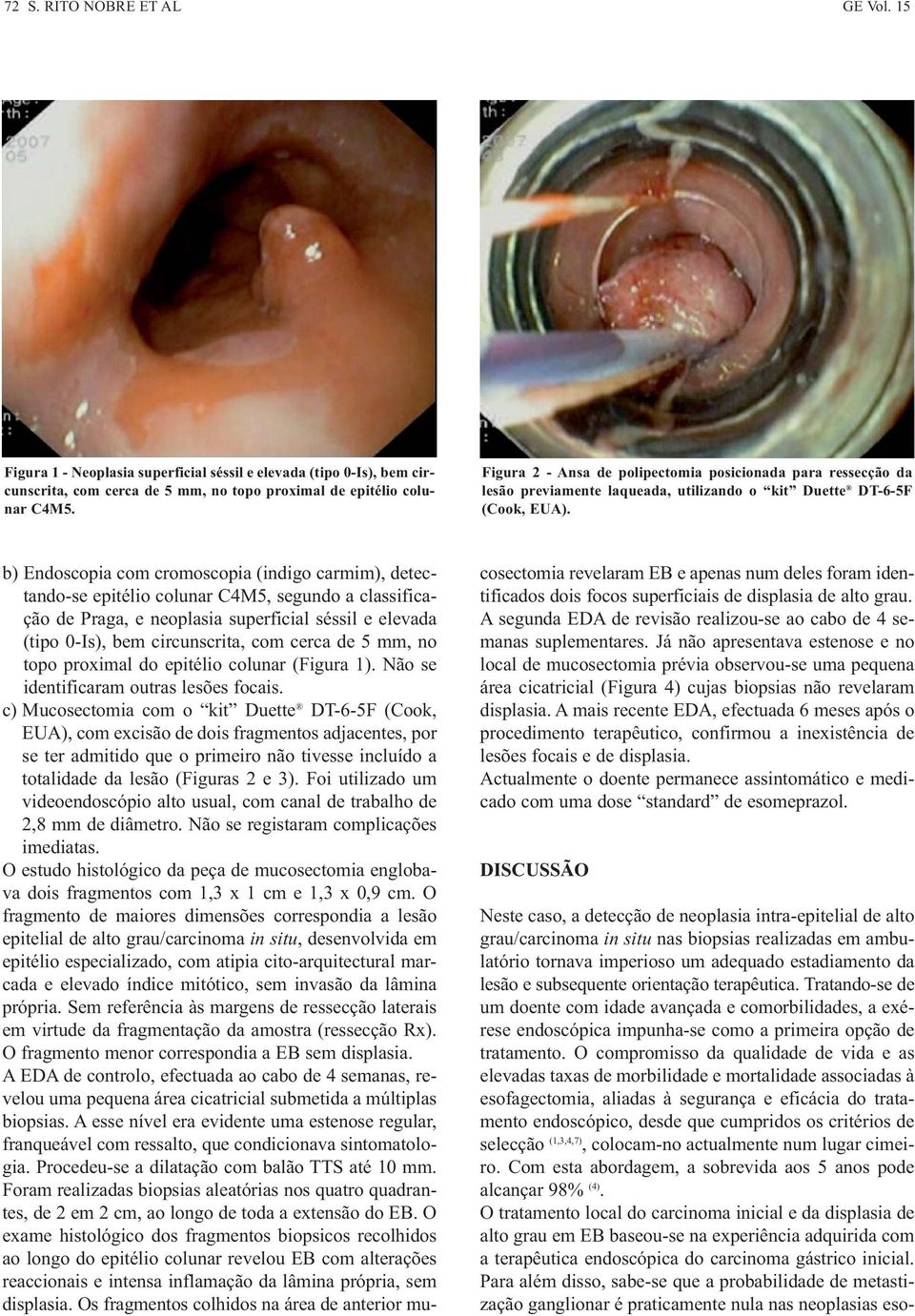 b) Endoscopia com cromoscopia (indigo carmim), detectando-se epitélio colunar C4M5, segundo a classificação de Praga, e neoplasia superficial séssil e elevada (tipo 0-Is), bem circunscrita, com cerca