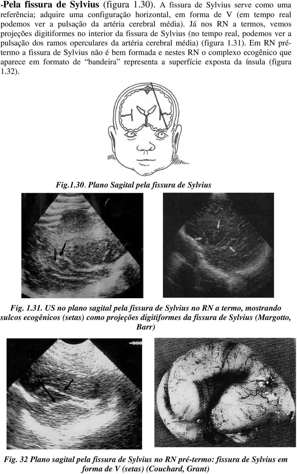 Já nos RN a termos, vemos projeções digitiformes no interior da fissura de Sylvius (no tempo real, podemos ver a pulsação dos ramos operculares da artéria cerebral média) (figura 1.31).