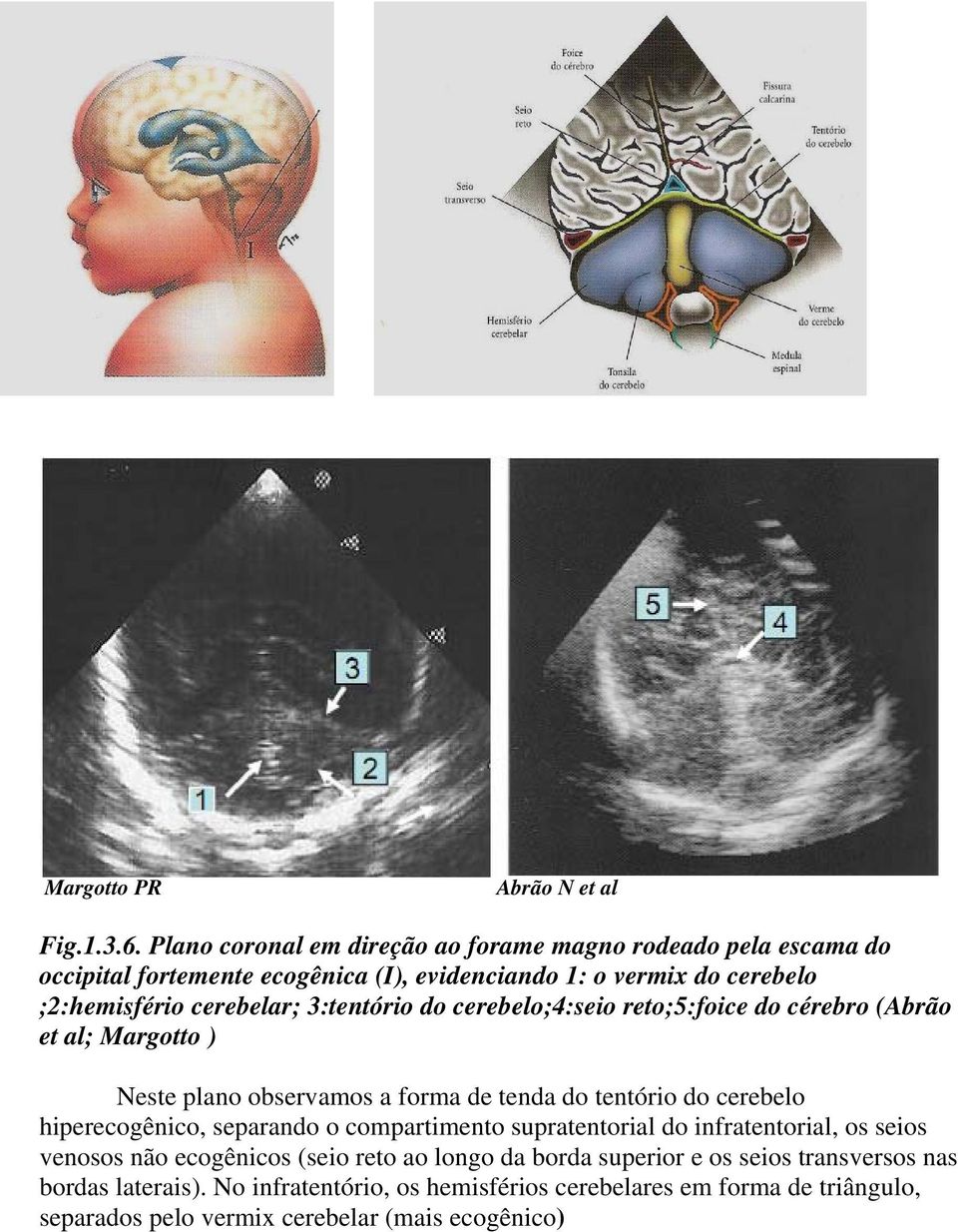 3:tentório do cerebelo;4:seio reto;5:foice do cérebro (Abrão et al; Margotto ) Neste plano observamos a forma de tenda do tentório do cerebelo hiperecogênico,