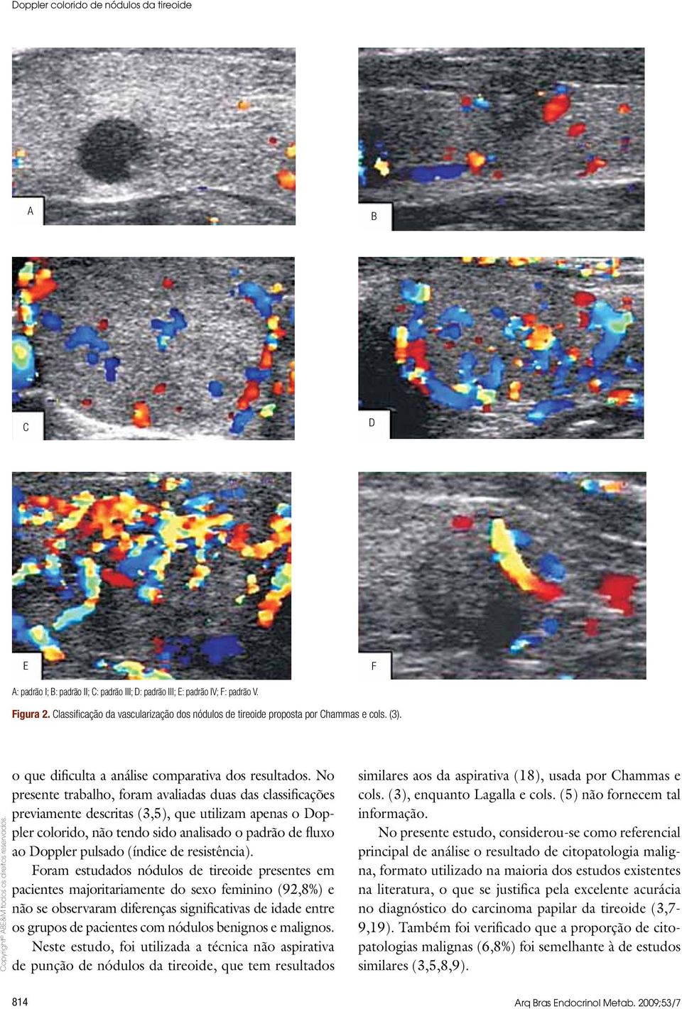 No presente trabalho, foram avaliadas duas das classificações previamente descritas (3,5), que utilizam apenas o Doppler colorido, não tendo sido analisado o padrão de fluxo ao Doppler pulsado